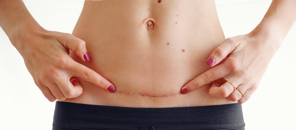 Closeup of woman belly with a scar from a cesarean section size isolated